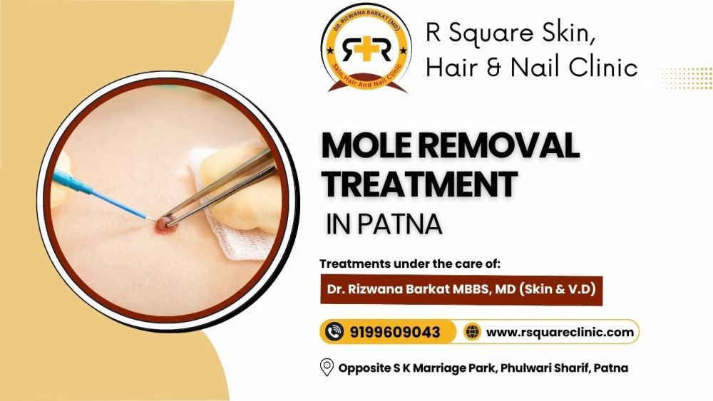 mole-removal-treatment-in-patna-from-dr-rizwana-barkat-big-0