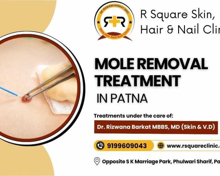 mole-removal-treatment-in-patna-from-dr-rizwana-barkat