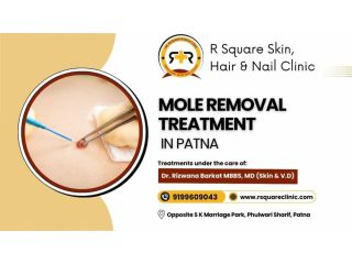 mole-removal-treatment-in-patna-from-dr-rizwana-barkat-small-0