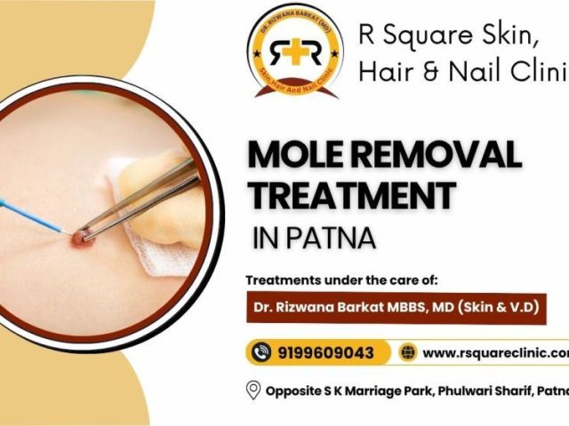 mole-removal-treatment-in-patna-from-dr-rizwana-barkat