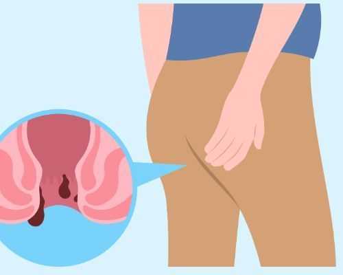 expert-ano-rectal-treatment-in-noida-for-piles-fissure