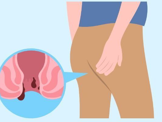expert-ano-rectal-treatment-in-noida-for-piles-fissure