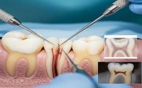 best-root-canal-treatment-in-chetla-for-pain-relief-big-0
