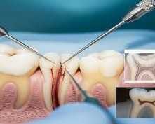 best-root-canal-treatment-in-chetla-for-pain-relief