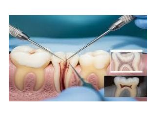 best-root-canal-treatment-in-chetla-for-pain-relief-small-0