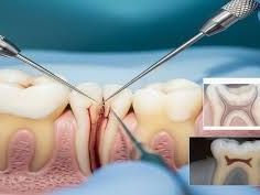 best-root-canal-treatment-in-chetla-for-pain-relief