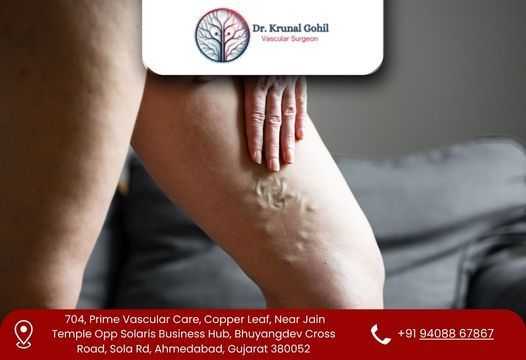 restore-healthy-legs-with-advanced-vein-care-big-0