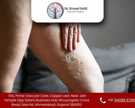 restore-healthy-legs-with-advanced-vein-care
