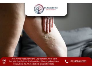 restore-healthy-legs-with-advanced-vein-care-small-0