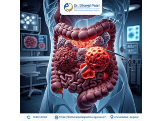 gi-cancer-surgery-with-personalized-care-by-dr-dhaval-patel-small-0