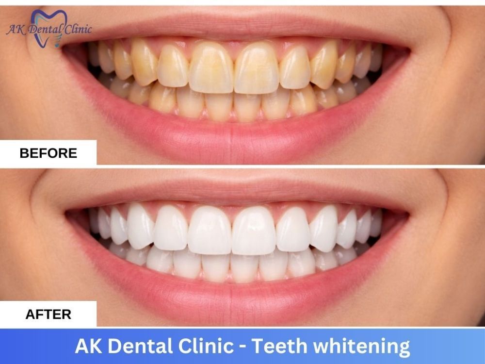 advanced-dental-teeth-whitening-in-mumbai-ak-dental-clinic-big-0