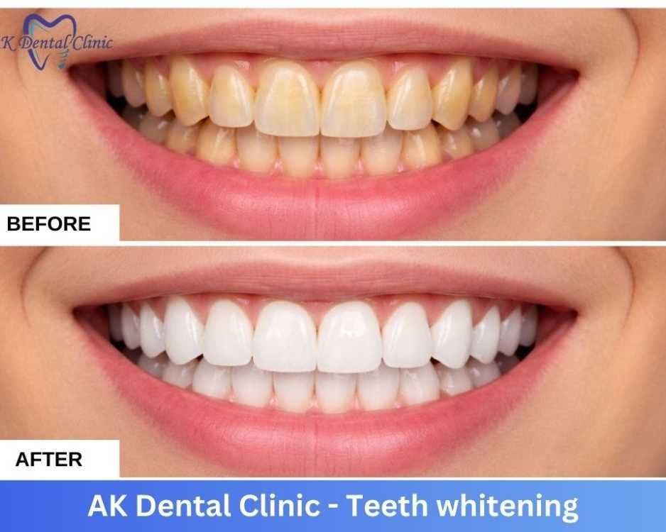 advanced-dental-teeth-whitening-in-mumbai-ak-dental-clinic