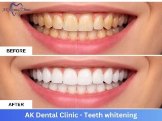 advanced-dental-teeth-whitening-in-mumbai-ak-dental-clinic-small-0