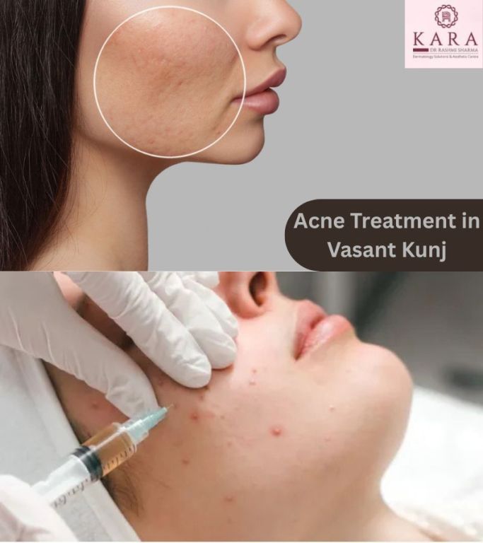 effective-solutions-for-acne-scars-at-kara-skin-clinic-big-0