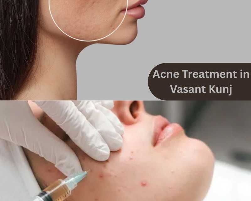 effective-solutions-for-acne-scars-at-kara-skin-clinic