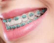 best-dental-brace-in-chetla-for-perfect-teeth-alignment