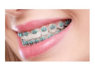 best-dental-brace-in-chetla-for-perfect-teeth-alignment-small-0