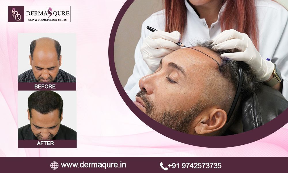 advanced-hair-transplant-treatment-in-surat-big-0
