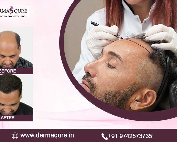advanced-hair-transplant-treatment-in-surat