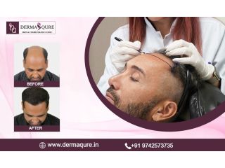 advanced-hair-transplant-treatment-in-surat-small-0