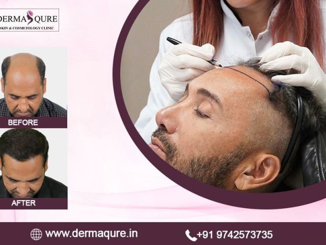 advanced-hair-transplant-treatment-in-surat
