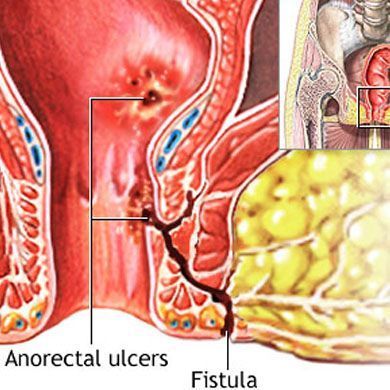 best-fistula-treatment-specialist-in-thane-west-call-now-big-0
