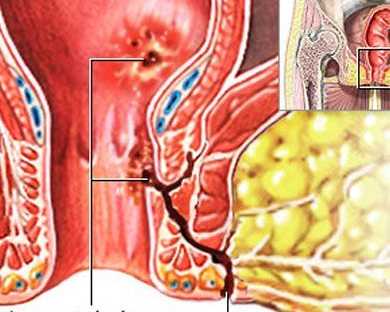 best-fistula-treatment-specialist-in-thane-west-call-now