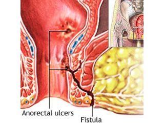 best-fistula-treatment-specialist-in-thane-west-call-now-small-0