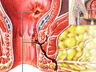 best-fistula-treatment-specialist-in-thane-west-call-now