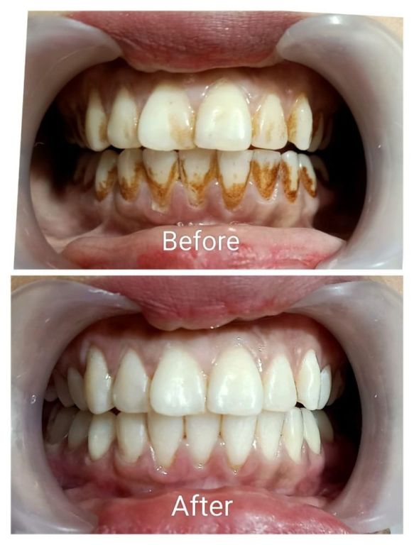 teeth-whitening-clinic-in-dwarka-sector-19-big-0