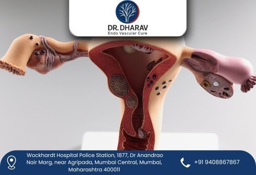 uterine-fibroid-embolization-by-dr-dharav-kheradia-big-0
