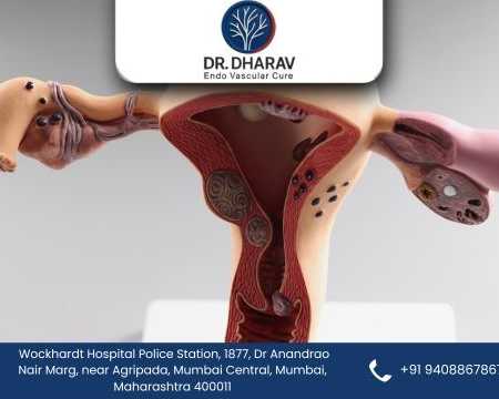 uterine-fibroid-embolization-by-dr-dharav-kheradia
