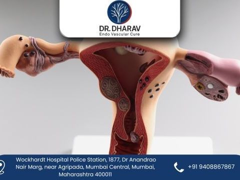 uterine-fibroid-embolization-by-dr-dharav-kheradia