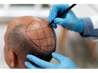 hair-loss-treatment-in-hyderabad-shlok-dermatology-small-0