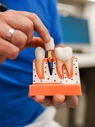 advanced-dental-implant-clinic-in-chetla-big-0