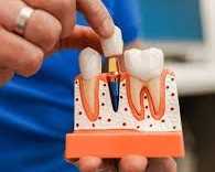 advanced-dental-implant-clinic-in-chetla