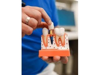 advanced-dental-implant-clinic-in-chetla-small-0
