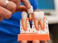 advanced-dental-implant-clinic-in-chetla
