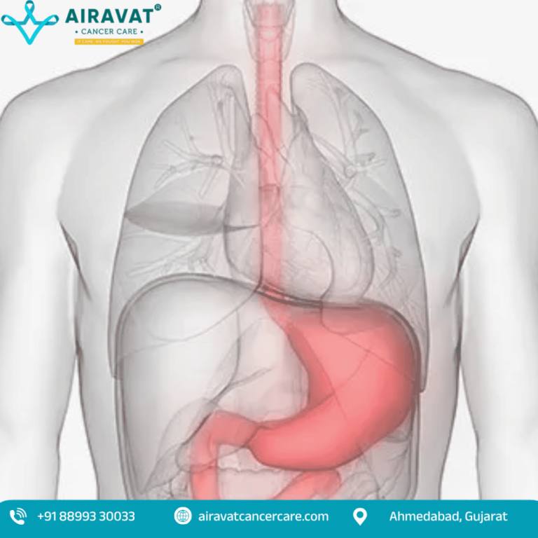 stomach-cancer-treatment-in-ahmedabad-airavat-cancer-care-big-0