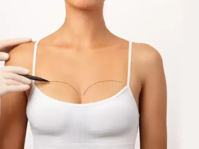 breast-lift-surgery-in-gurgaon-with-dr-shilpi-bhadani