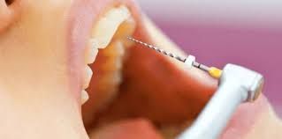 best-root-canal-treatment-in-chetla-big-0