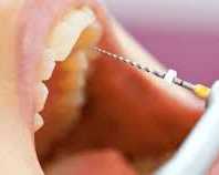 best-root-canal-treatment-in-chetla