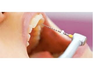best-root-canal-treatment-in-chetla-small-0