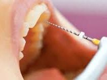 best-root-canal-treatment-in-chetla