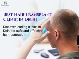 best-hair-transplant-clinic-in-delhi-for-permanent-results-small-0