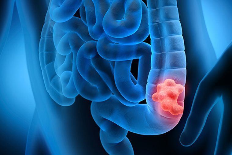 best-colon-cancer-treatment-in-ahmedabad-with-expert-oncologists-big-0