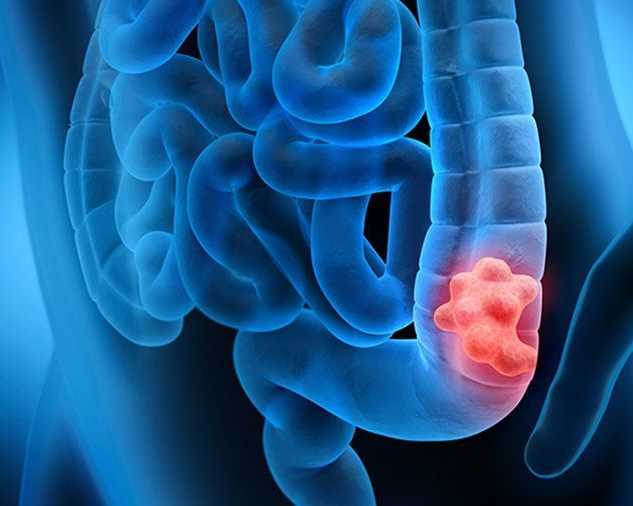 best-colon-cancer-treatment-in-ahmedabad-with-expert-oncologists