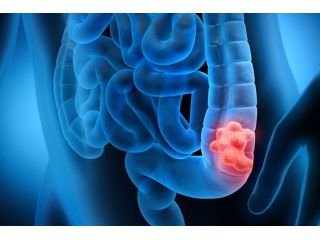 best-colon-cancer-treatment-in-ahmedabad-with-expert-oncologists-small-0