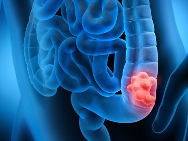 best-colon-cancer-treatment-in-ahmedabad-with-expert-oncologists