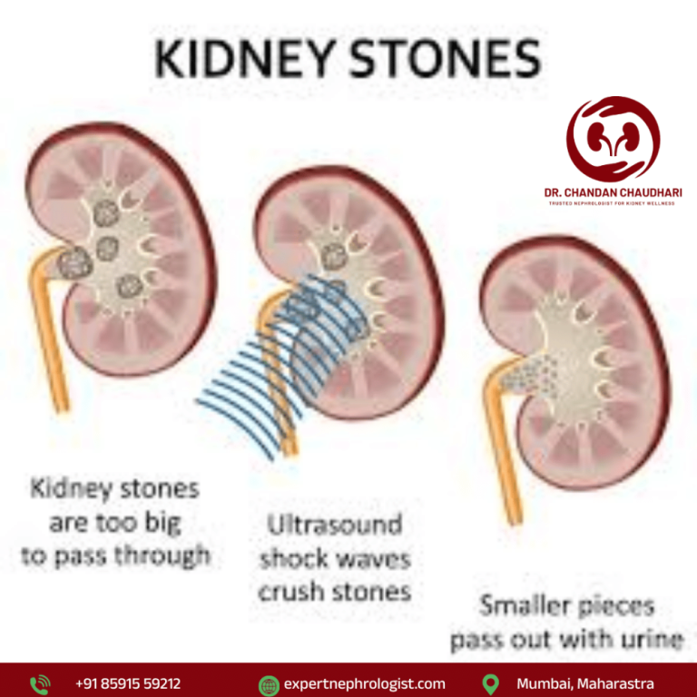 kidney-stone-treatment-in-mumbai-by-an-expert-kidney-specialist-big-0
